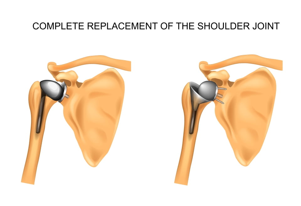 解剖和反向肩部替代品
